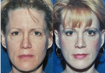 Facelift Before and After Photos