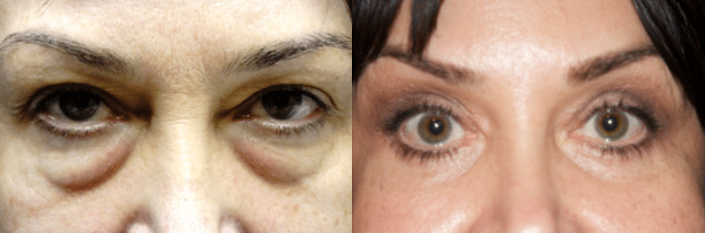 Eyelid LIft Before and After Photos