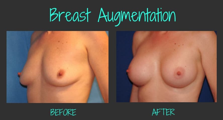 36035-5086-31121-7235-BreastAugBA-Blog