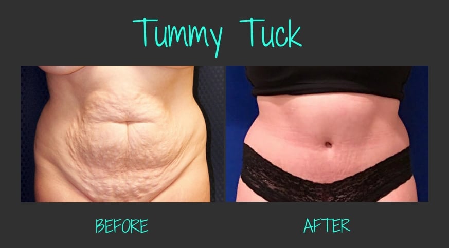 64119-50251-46313-49911-TummyTuckBA-Blog