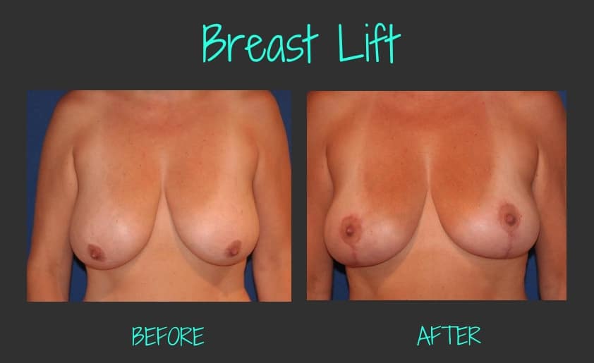 72493-8476-16403-3186-BreastLiftBA-Blog