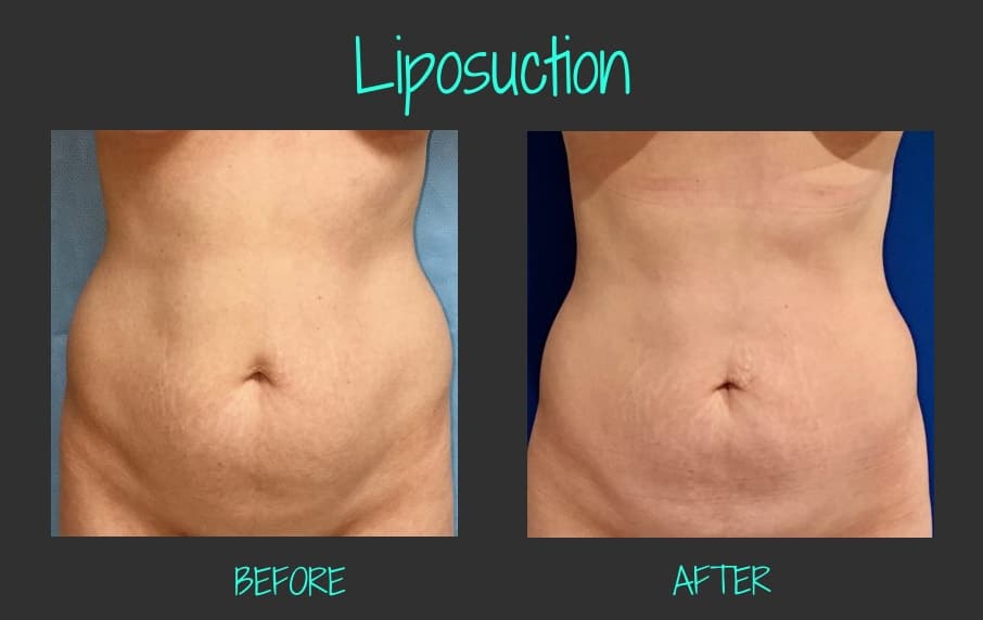 IMG_0361_1619-LiposuctionBA-Blog