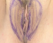 Vaginal Rejuvenation 01 Before 1