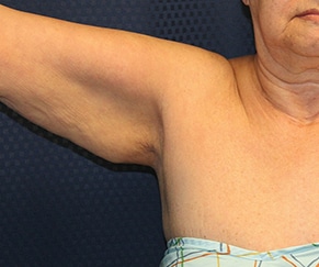 Arm Lift 01 Before 1