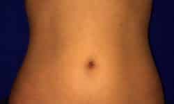 CoolSculpting 02 After