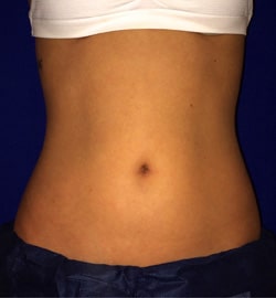 CoolSculpting 02 After 1