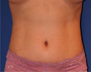 Tummy Tuck 08 After 1