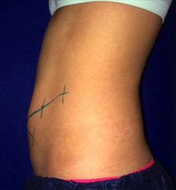 CoolSculpting 02 Before 3