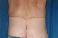 Tummy Tuck 09 After 3