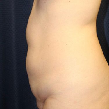 Liposuction 02 Before 2