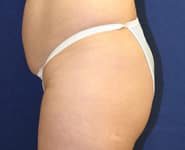 Fat Transfer / Brazilian Butt Lift 04 Before 1