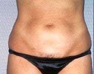 Tummy Tuck 13 Before