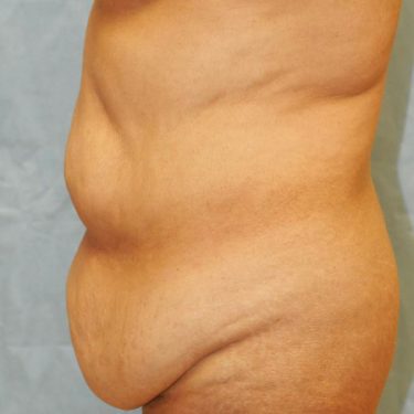 Tummy Tuck 02 Before 2