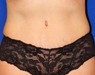 Tummy Tuck 07 After 1