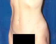 Tummy Tuck 12 After 3