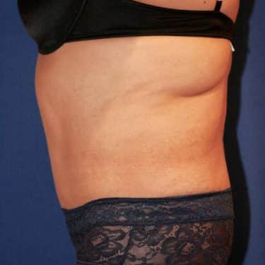 Tummy Tuck 02 After 2