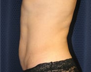 Tummy Tuck 08 Before 2