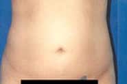 Liposuction 05 Before 1