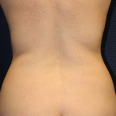Liposuction 02 Before 3