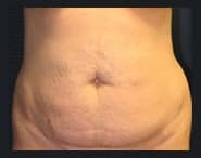 Tummy Tuck 05 Before 1