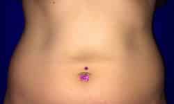 CoolSculpting 01 Before