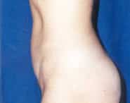 Tummy Tuck 12 After 2