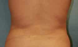 Liposuction 01 Before