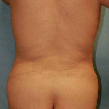Liposuction 01 Before 1