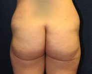 Fat Transfer / Brazilian Butt Lift 02 Before