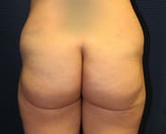 Fat Transfer / Brazilian Butt Lift 02 Before 1