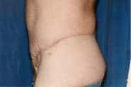 Tummy Tuck 09 After 2
