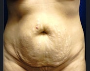 Tummy Tuck 07 Before 1