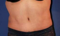 Tummy Tuck 02 After