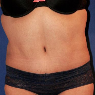 Tummy Tuck 02 After 1