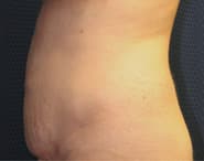 Tummy Tuck 05 Before 2