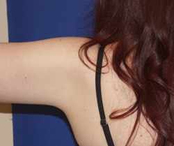 Arm Lift 02 Before 3