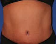 Tummy Tuck 06 After 1