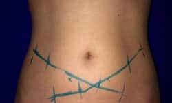 CoolSculpting 02 Before