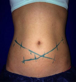 CoolSculpting 02 Before 1