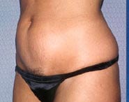 Tummy Tuck 13 Before 2