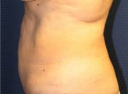 Tummy Tuck 04 Before 2