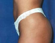 Tummy Tuck 13 After 3