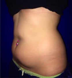 CoolSculpting 01 Before 2