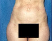 Tummy Tuck 12 Before 1