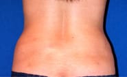 Liposuction 03 After 3