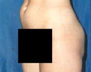 Tummy Tuck 12 Before 3