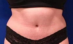 Tummy Tuck 01 After