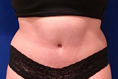 Tummy Tuck 01 After 1