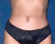 Tummy Tuck 10 After