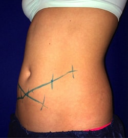 CoolSculpting 02 Before 2